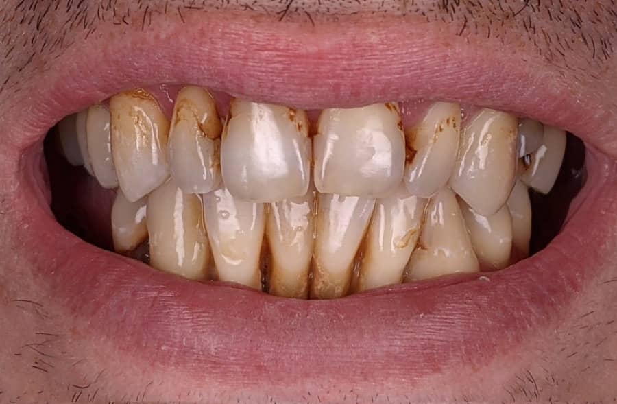 Before: a Regency Square Dental patient's smile prior to treatment.