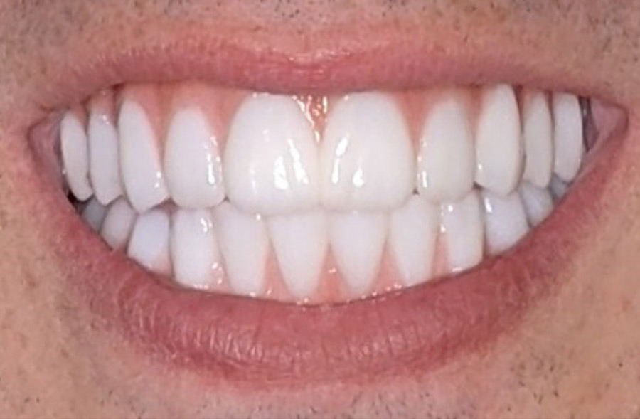 After: the same patient's completed Regency Square Dental restoration.