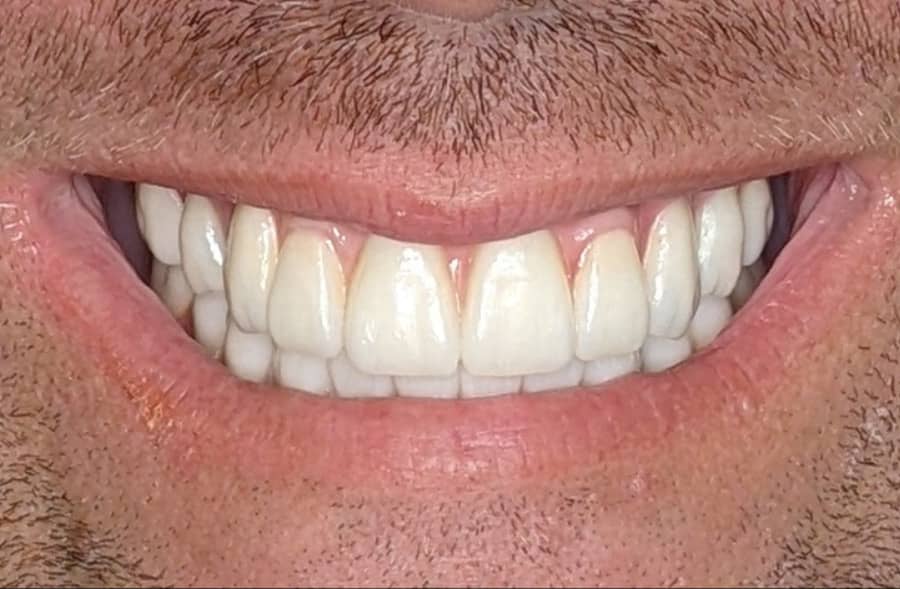 After: the same patient's completed Regency Square Dental restoration.