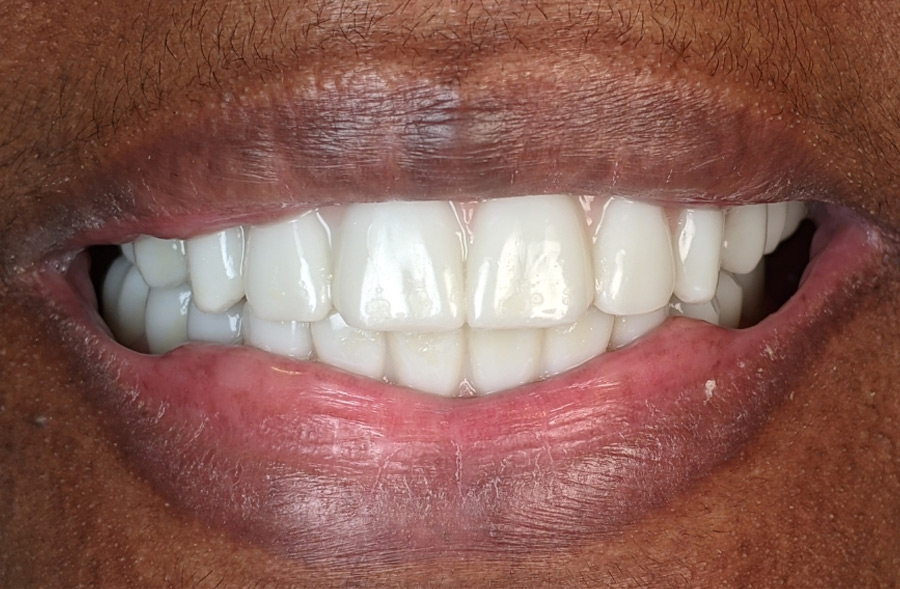 After: the same patient's completed Regency Square Dental restoration.