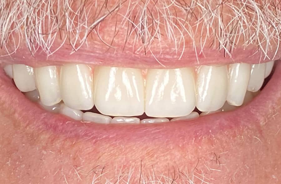 After: the same patient's completed Regency Square Dental restoration.