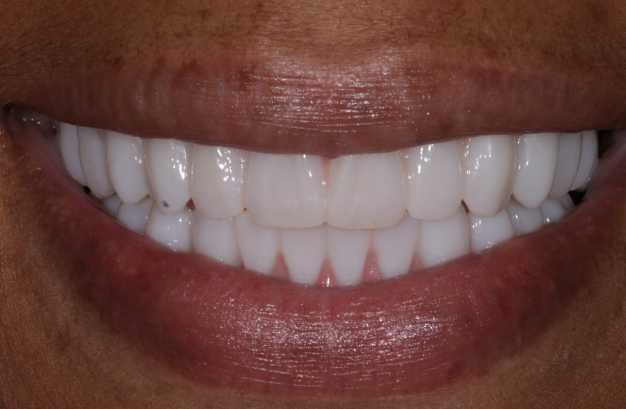 After: the same patient's completed Regency Square Dental restoration.