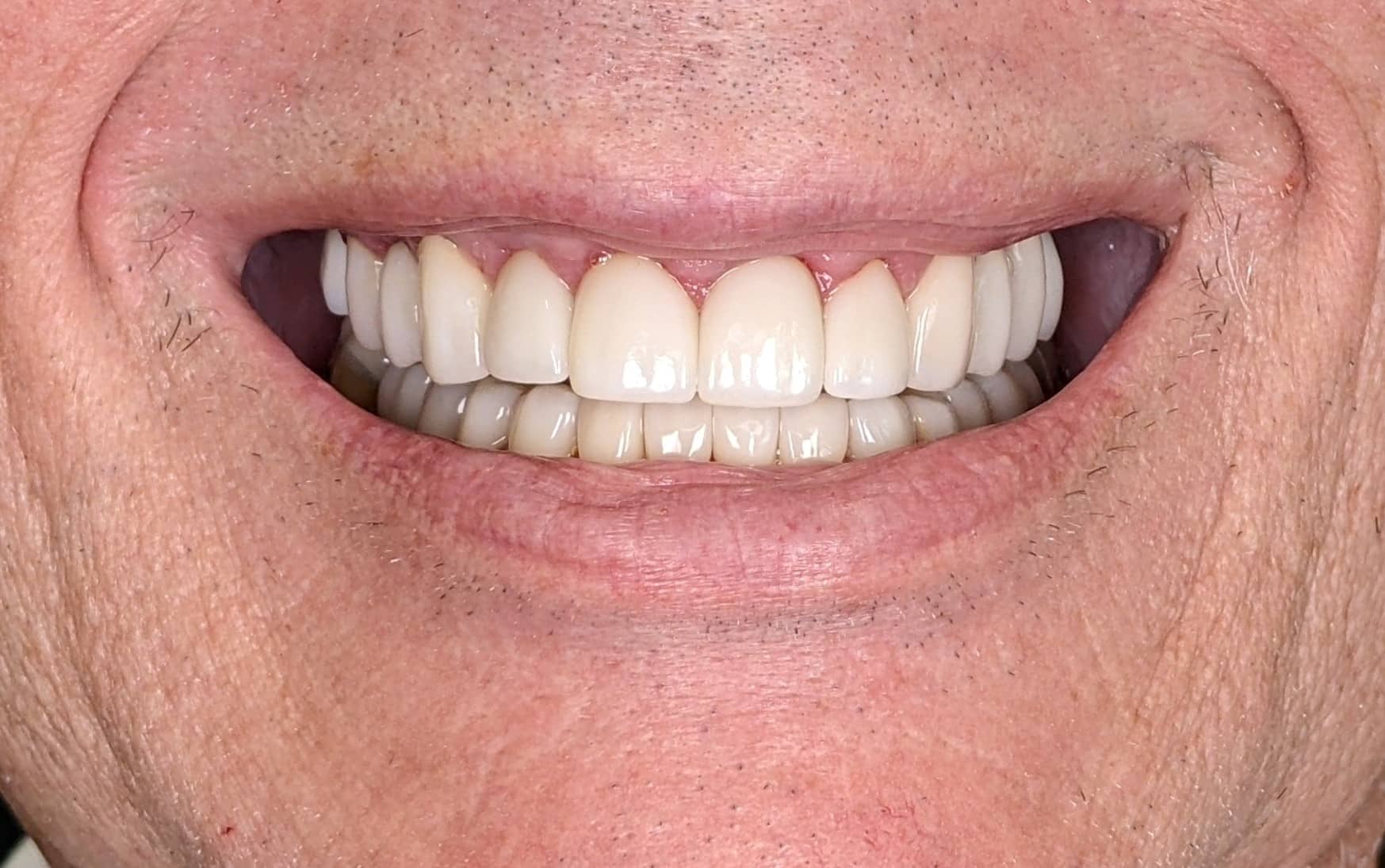 After: the same patient's completed full-arch PrecisionSmile implant restoration, upper and lower.