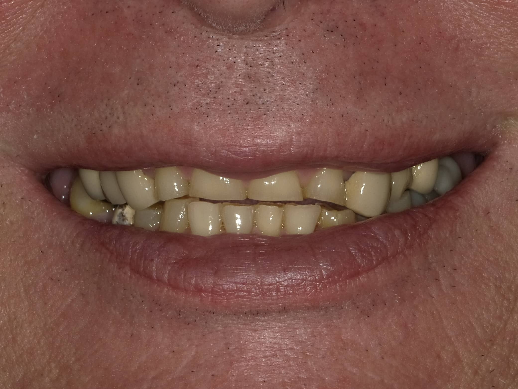 Before: worn, uneven, and discolored teeth prior to full-arch restoration at Regency Square Dental.