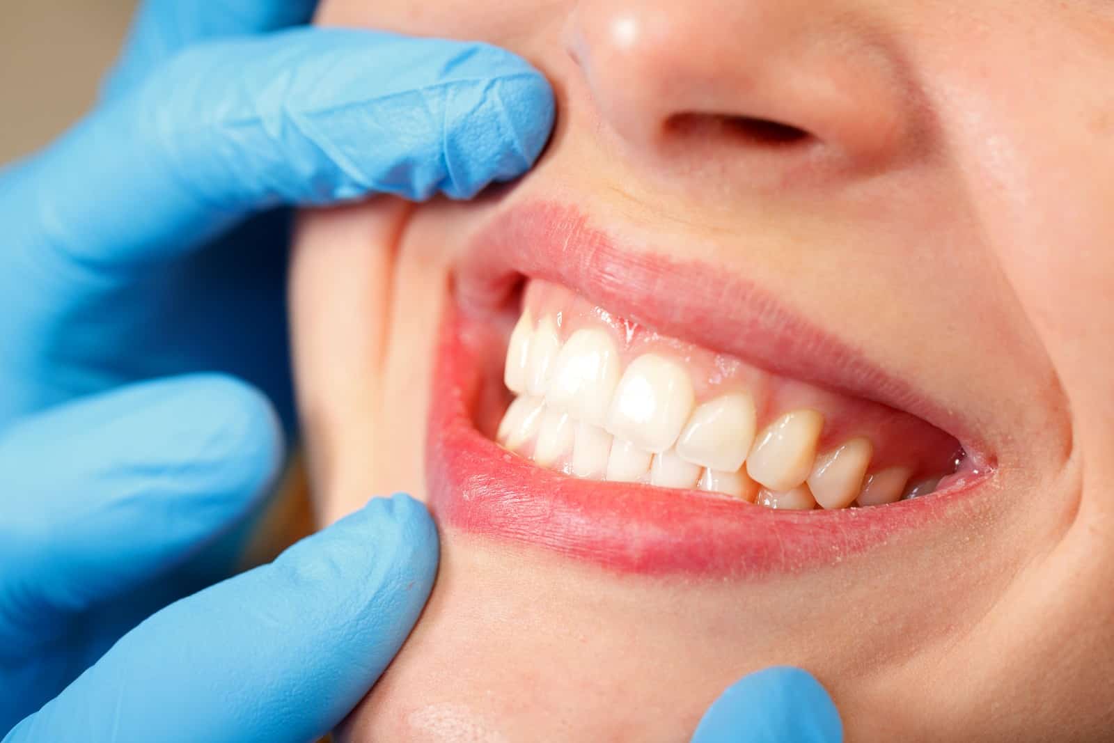Close-up of finished porcelain veneers placed at Regency Square Dental in Davie.